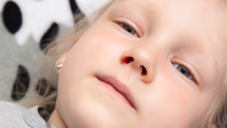 krvacanie z nosa deti