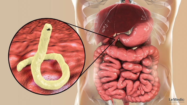 Ilustrácia parazita v črevách človeka s detailným záberom na červy v tráviacom systéme.