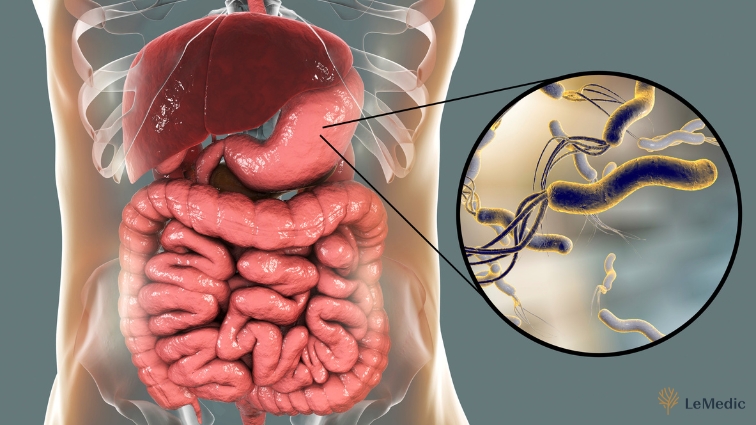 Ilustrácia tráviaceho systému s detailným pohľadom na baktériu helikobakter pylori, zdôrazňujúca jej prítomnosť v žalúdku a jej vplyv na tráviace zdravie.