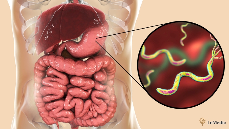 Grafické zobrazenie tráviaceho systému s detailným pohľadom na baktériu helikobakter pylori, zvýrazňujúce jej výskyt v žalúdku a jej úlohu pri tráviacich ťažkostiach.